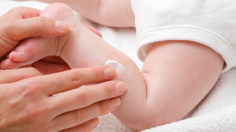 Крапивница у детей